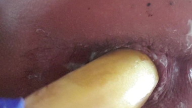 Doctor, please get the banana out of my ass